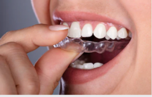 Invisalign Adelaide