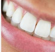 Adelaide Teeth Whitening