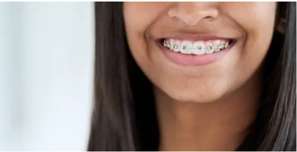 dental braces Adelaide